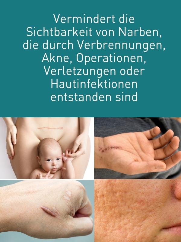 N1 Narben Gel 19 g - N1 - SHOP