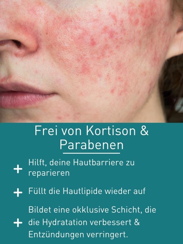 N1 Rosacea Creme 30 ml - N1 - SHOP