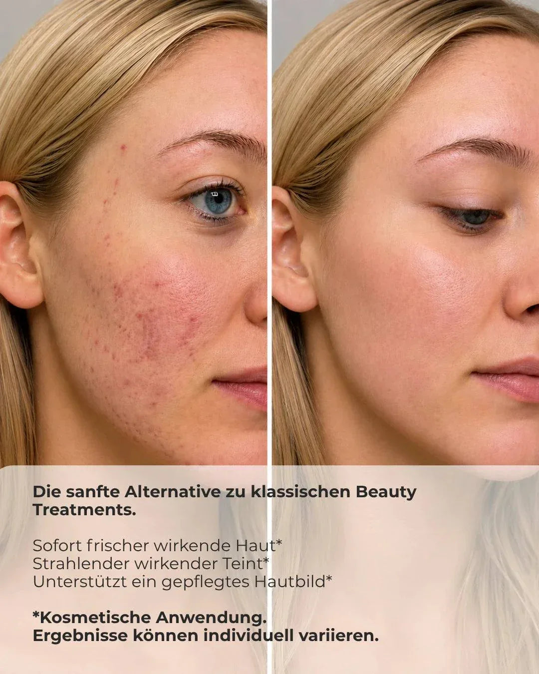 N1 My Coldplasma Hautpflegegerät für Zuhause zur Hautverschönerung