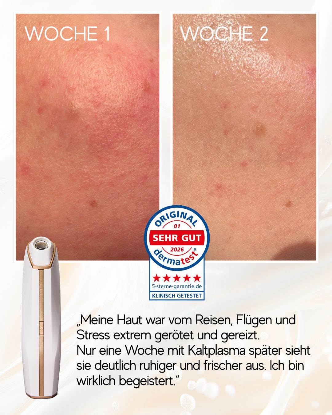 N1 My Coldplasma Gerät für Hautverschönerung zu Hause