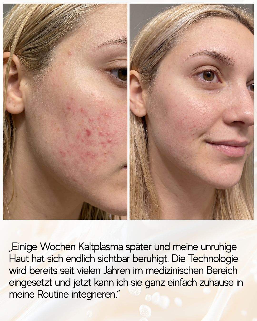 N1 My Coldplasma Hautpflegegerät für strahlende Schönheit