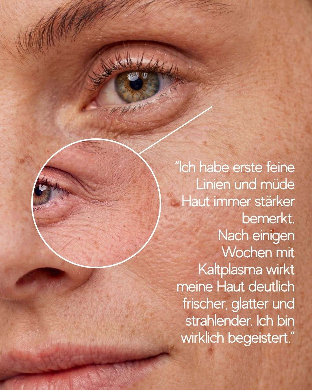 My Coldplasma Hautpflegegerät N1 für strahlende Haut