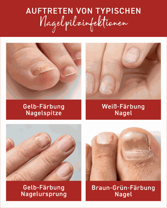 Typische Nagelpilzinfektionen, Farbveränderungen an Nägeln, Behandlung mit Nagelpilz Lösung.