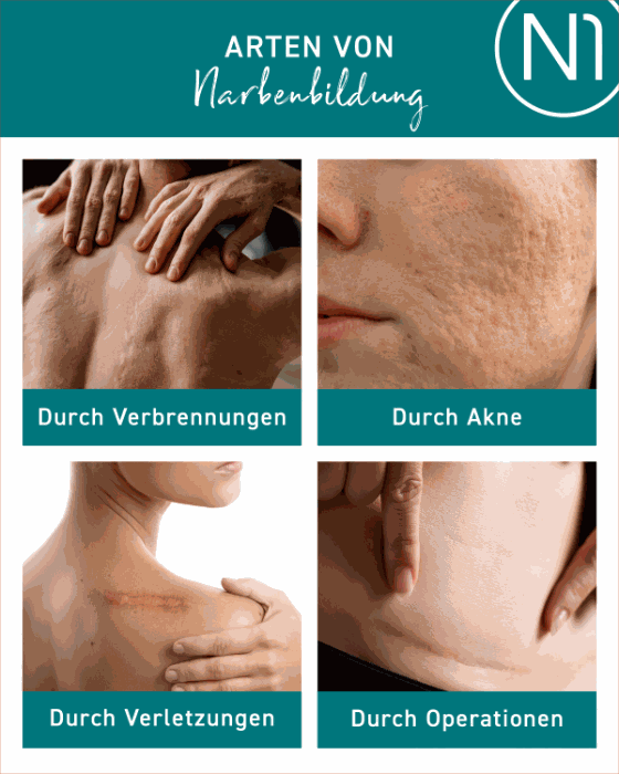 Arten von Narbenbildung: Verbrennungen, Akne, Verletzungen, Operationen mit N1 Narben Gel.