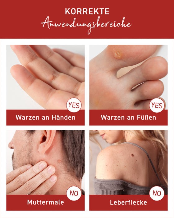 Korrekte Anwendungsbereiche der N1 Warzen Tinktur für Hände und Füße, nicht geeignet für Muttermale und Leberflecken.