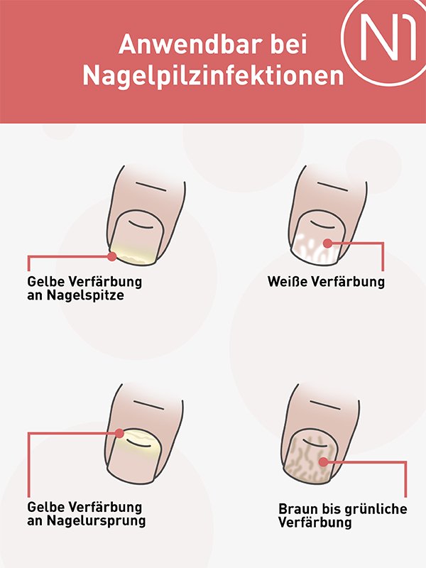 N1 Nagelpilzlösung mit patentiertem Wirkstoff, 10 ml - N1 - SHOP